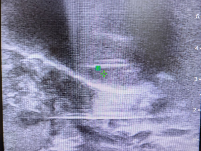 Perineale Fusionsbiopsie (webpotimiert)